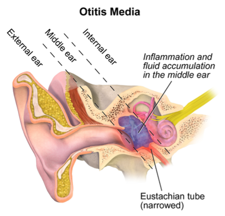 Otitis in the ear